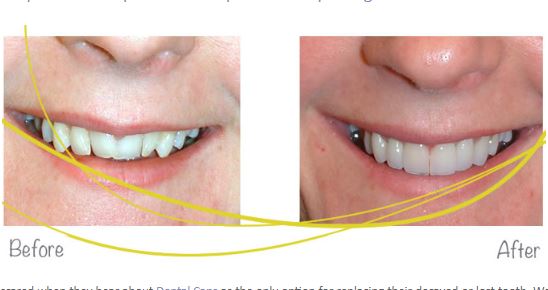 Image for Teeth Veneers Miami with ID of: 3443648