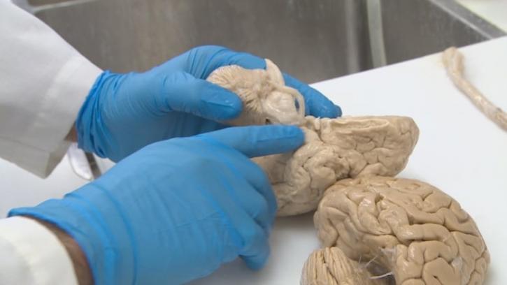 Image for Brain Only Autopsy with ID of: 3455129