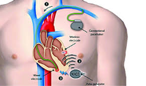 Image for Cardiac Pacemaker Market Study By Type, Technology & Top Key Players - BIOTRONIK SE & Co. KG, Boston Scientific Corp., Cook Medical Inc., MEDICO S.p.A., Medtronic with ID of: 3465852