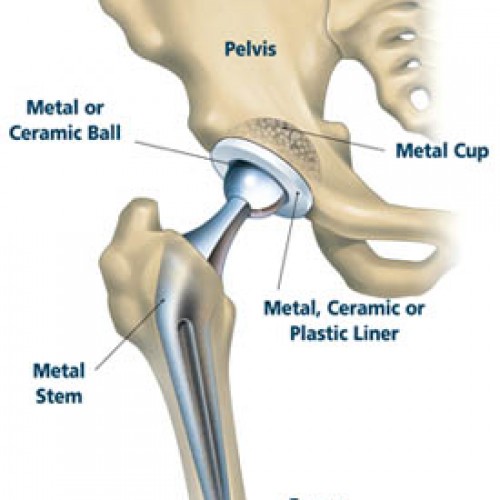 Image for Affordable Total hip replacement cost India with ID of: 3478801