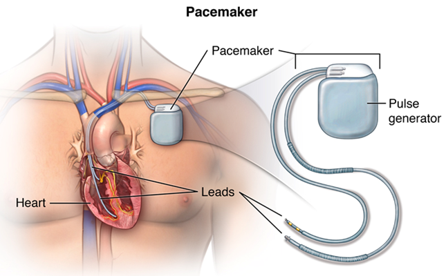 Image for Check The Pacemaker Surgery Cost In India - Credihealth with ID of: 3480600