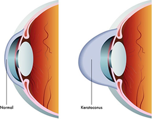 Image for Keratoconus treatment in India with ID of: 3485635