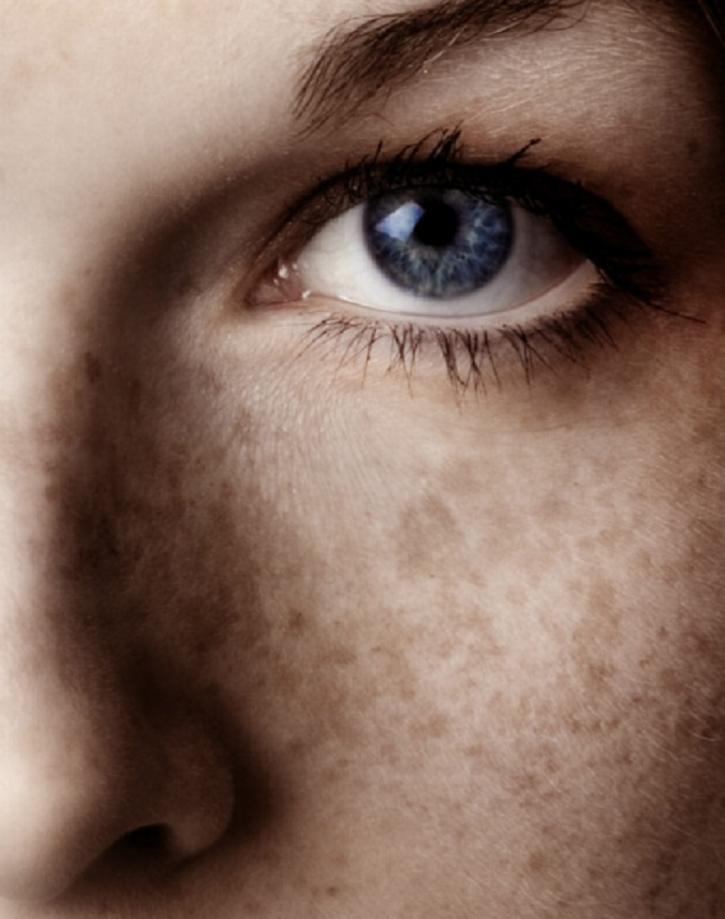 Image for Know Your Skin: The Difference Between Hyperpigmentation and Melasma with ID of: 3496556