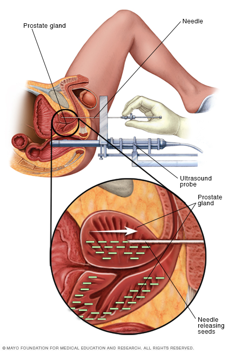 Image for Brachytherapy Market Study By Technique, Application & Top Key Players - Boston Scientific Corporation, C. R. Bard, Inc., C4 Imaging, L.L.C., Cianna Medical, Inc. with ID of: 3524276