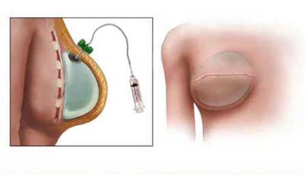 Image for Tissue Expander Market Study By End-Use, Shape, Application & Top Key Players - Allergan plc, GC Aesthetics, GROUPE SEBBIN SAS, Guangzhou Wanhe Plastic Materials Co., Ltd., KOKEN CO., LTD. with ID of: 3533697