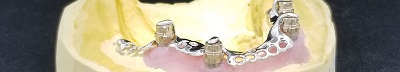 Image for Custom Dental Prosthetics with ID of: 3533962
