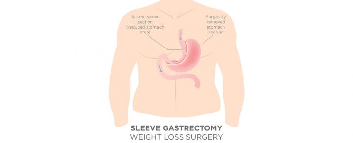 Image for Gastric Bypass Surgery with ID of: 3602543