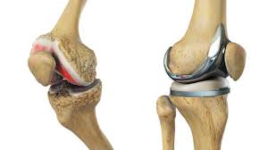 Image for Global Bone Replacement Products Market - Industry Trends, Analysis And Growth By 2025 with ID of: 3631285