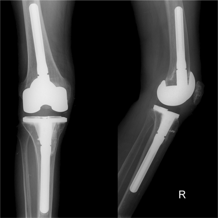 Image for Antibiotic Bone Cement and Casting Materials Market Forecast to 2026 with Key Companies Profile, Supply and Growth Factors with ID of: 3644656