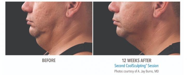Image for Fat Freeze Sculpting with ID of: 3671643