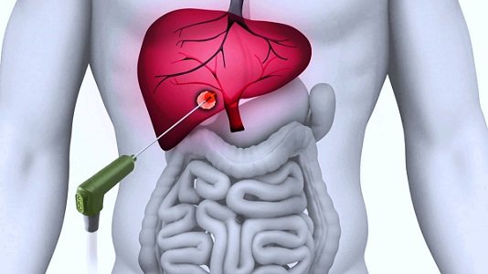 Image for Ablation Technologies Market To 2025, Size, Share Analysis by Key Players - Medtronic PLC, Biosense Webster, Inc. (A Subsidiary of Johnson & Johnson Inc.), St. Jude Medical, Inc. with ID of: 3673424