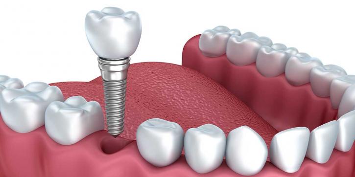 Image for Dental Implants Market to Partake Significant Development By 2026 with ID of: 3681025