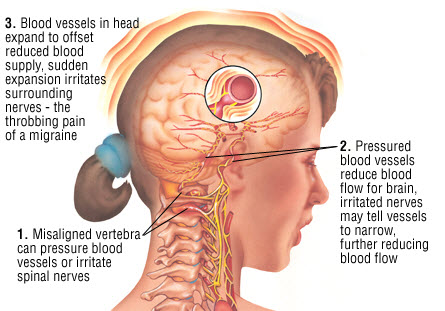 Image for MIGRAINE HEADACHE TREATMENT with ID of: 3683830