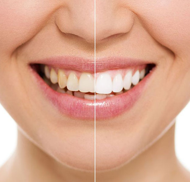 Image for All On 4 Dental Implants with ID of: 3697316