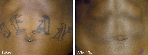 Image for Ink Doubt - Laser Tattoo Removal with ID of: 3715814