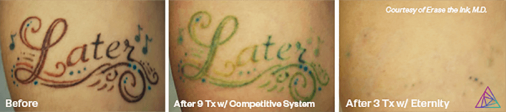 Image for Ink Doubt - Laser Tattoo Removal with ID of: 3715815