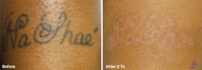 Image for Ink Doubt - Laser Tattoo Removal with ID of: 3715817