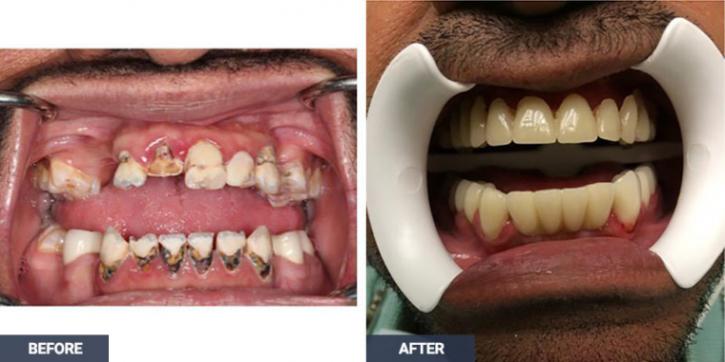 Image for Cavity Filling with ID of: 3717190