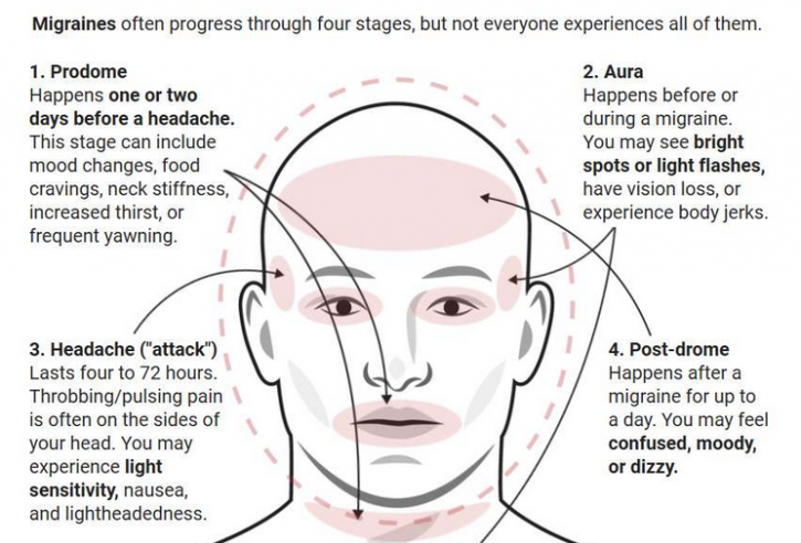 Image for POSTDROME MIGRAINE with ID of: 3718166