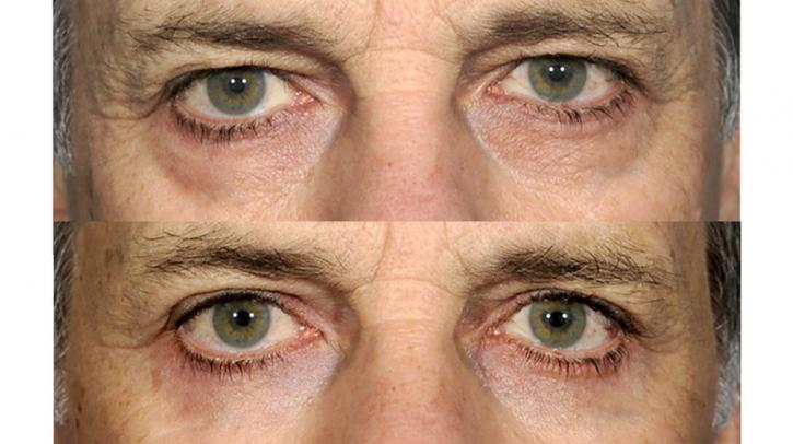Image for Eye Bag Surgery with ID of: 3726819