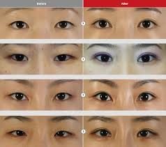 Image for Eyelid Surgery with ID of: 3727159