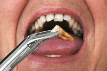Image for Different Options for Dental Implants in Plainfield IL (Illinois) with ID of: 3759115