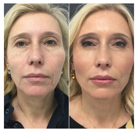 Image for Botox Injection with ID of: 3777534
