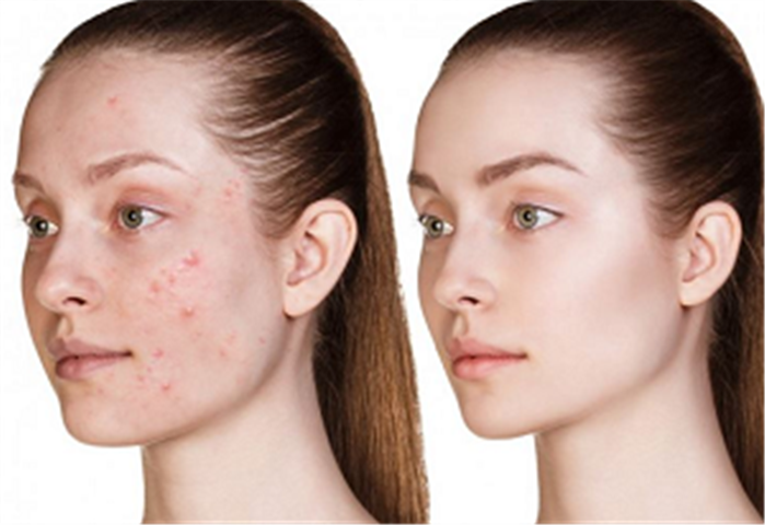 Image for Microdermabrasion Facial with ID of: 3782315