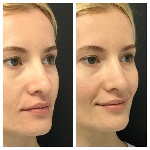Image for Microdermabrasion Facial with ID of: 3782381