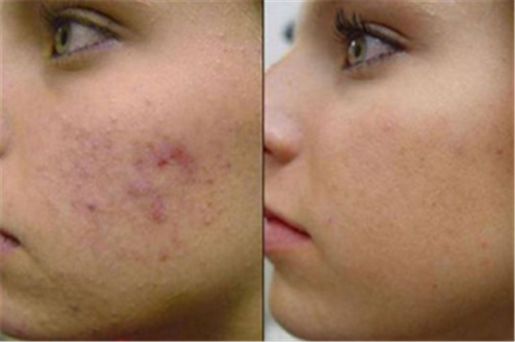 Image for Chemical Peel with ID of: 3785158