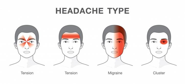 Image for migraine headache symptoms with ID of: 3833219