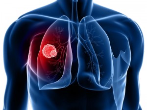 Image for Comprehensive Study Reveals that How Lung Cancer Screening Software Market is Trending with ID of: 3844306