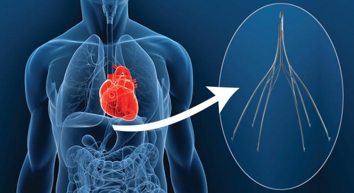 Image for Global Inferior Vena Cava (IVC) Filters Market Manufacturers Sales Analysis Report 2019-2024 with ID of: 3863576