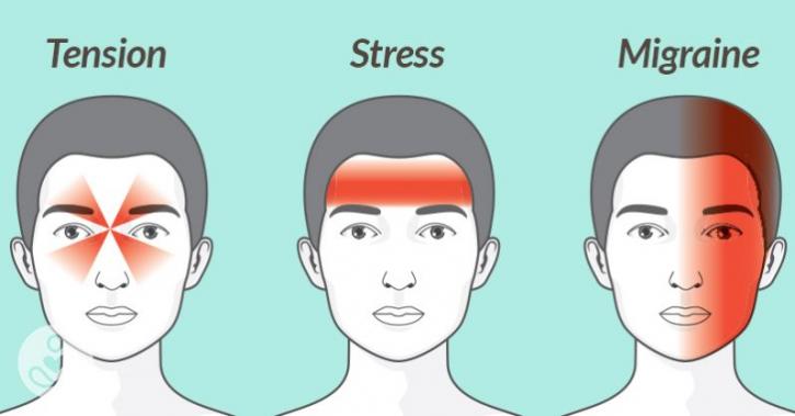 Image for migraine headaches with ID of: 3881357