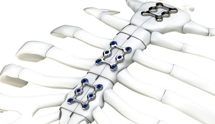 Image for Sternal Closure Systems Market Hit at a CAGR of 5.4% In Terms Of Revenues from 2018 to 2025 with ID of: 3895377