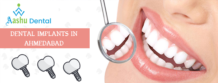 Image for Dental implants in Ahmedabad with ID of: 3898791