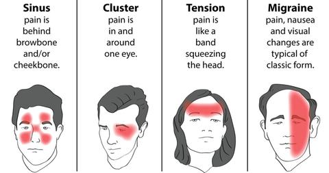Image for migraine headache with ID of: 3922999