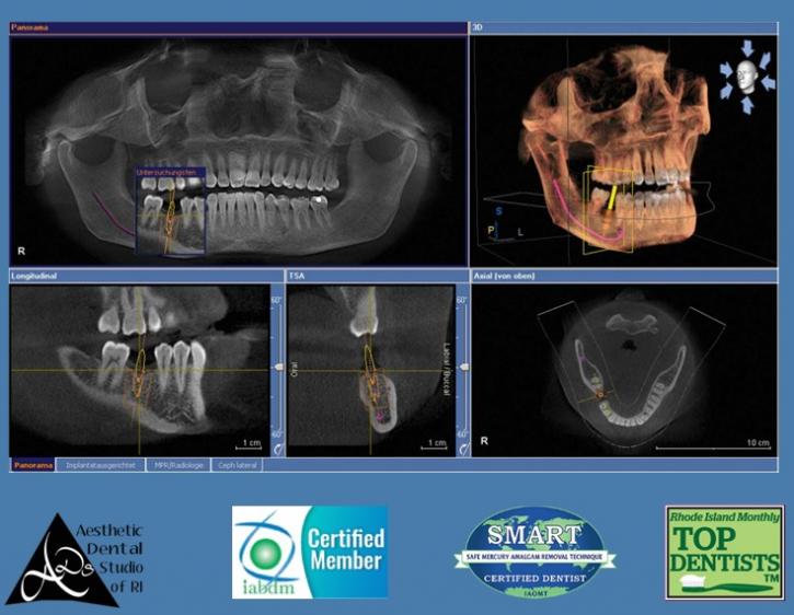 Image for CBCT 3D DENTAL IMAGING, SMART PROTOCOL DENTIST, MERCURY FREE, BIOLOGICAL CERTIFIED DENTIST RI with ID of: 3976011