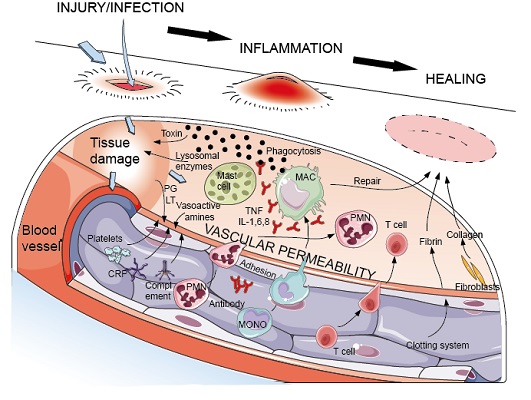 Image for acute inflammation with ID of: 3993718