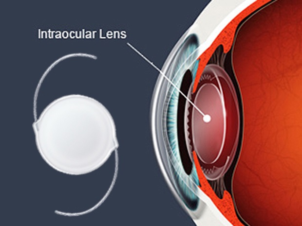 Image for Landscape of the Worldwide Intraocular Lens Market Outlook: Ken Research with ID of: 4002575