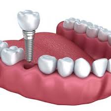 Image for Know the Latest Study of the Global Dental Implant Market 2020 in the Industry with Prominent Players with ID of: 4016425