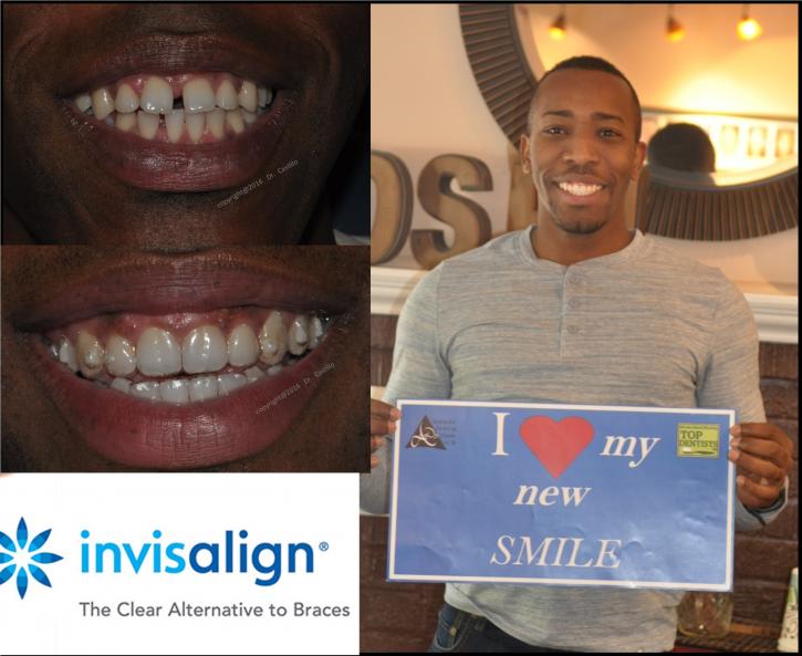 Image for Invisalign Options with ID of: 4024980