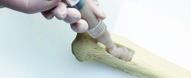 Image for Bone Grafts & Substitutes Market Size Worth $3.54 Billion By 2026 with ID of: 4028624