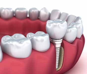 Image for Dental Implants Hanford CA with ID of: 4044337