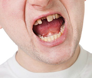 Image for Dental Implant Procedure Hanford CA with ID of: 4044377
