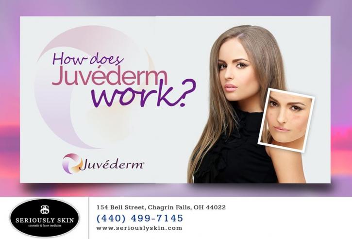 Image for Juvederm Treatment Cleveland with ID of: 4129802