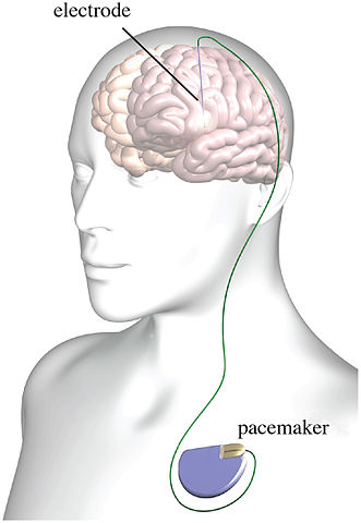 Image for Deep Brain Stimulation Devices Market Size, Share, Growth, Trends and Forecast Report, 2020 to 2027 with ID of: 4177482