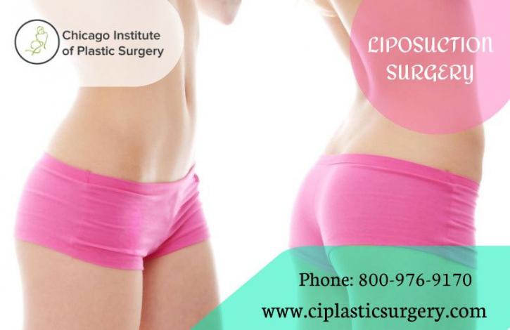 Image for What Should You Know About Having Liposuction Surgery in Chicago? with ID of: 4228522