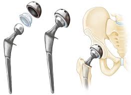 Image for World Hip Replacement Implants Market: Market Size,Industry Growth and Forecast Report Till 2023 with ID of: 4238385