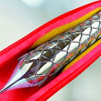 Image for Global Interventional Cardiology & Peripheral Vascular Devices Market 2020 | Manufacturers, Regions, Type and Application, Forecast to 2025 with ID of: 4304059